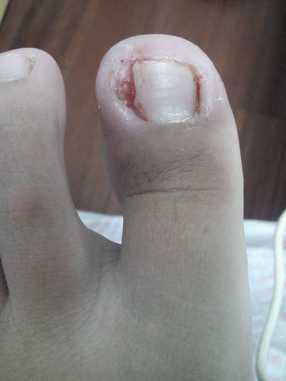 医生治理甲沟炎,医生对甲沟炎的看法