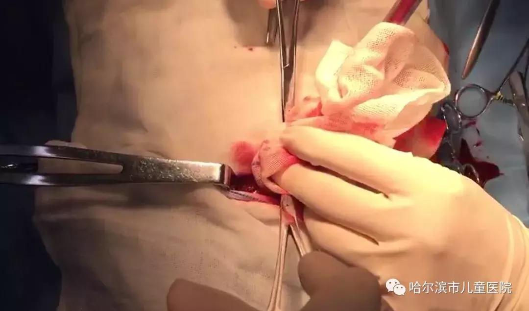 哈尔滨市儿童医院多学科团队齐心救治4岁男孩肝破裂Ⅴ级严重外伤