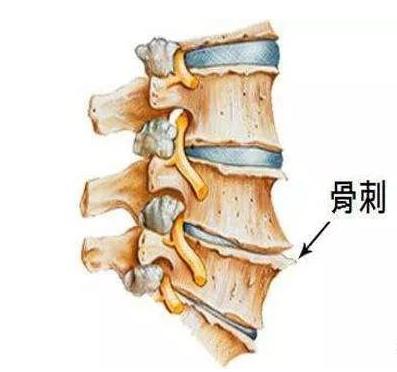 颈椎长骨刺该怎么治疗呢,颈椎骨刺有什么说法