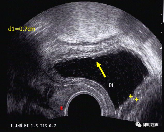 膀胱超声图解大全,膀胱超声解剖及常见病变超声表现