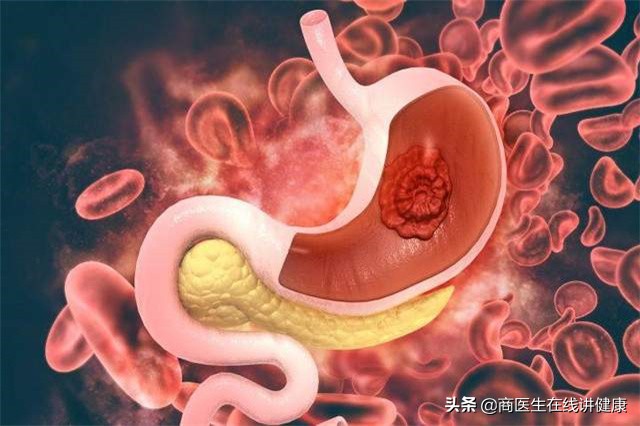 烧心反酸怎么办最快最有效的方法,孕晚期胃反酸水烧心怎么快速缓解