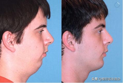 鐗欓娇澶栧嚫涓嬪反鍚庣缉鎬庝箞鐭,涓颁笅宸村彲浠ユ敼鍠勭墮榻垮悗缂╁悧