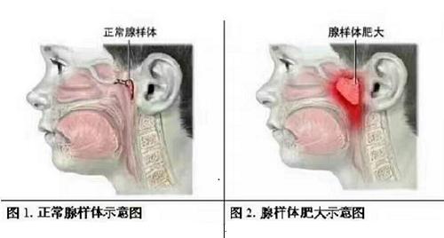 孩子打鼾别大意警惕腺样体肥大,孩子打鼾一定是腺样体肥大么