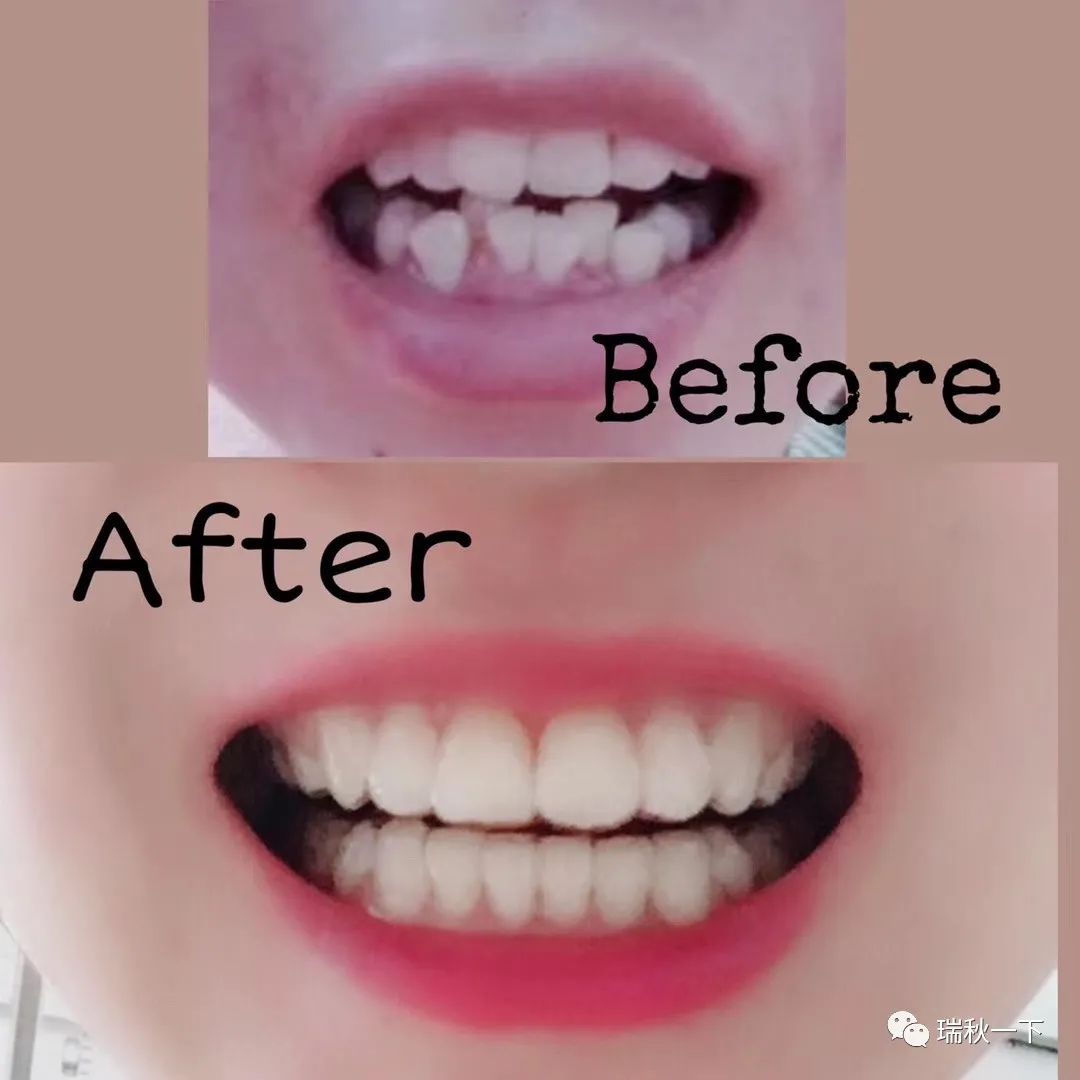 牙齿矫正，你后悔了吗？