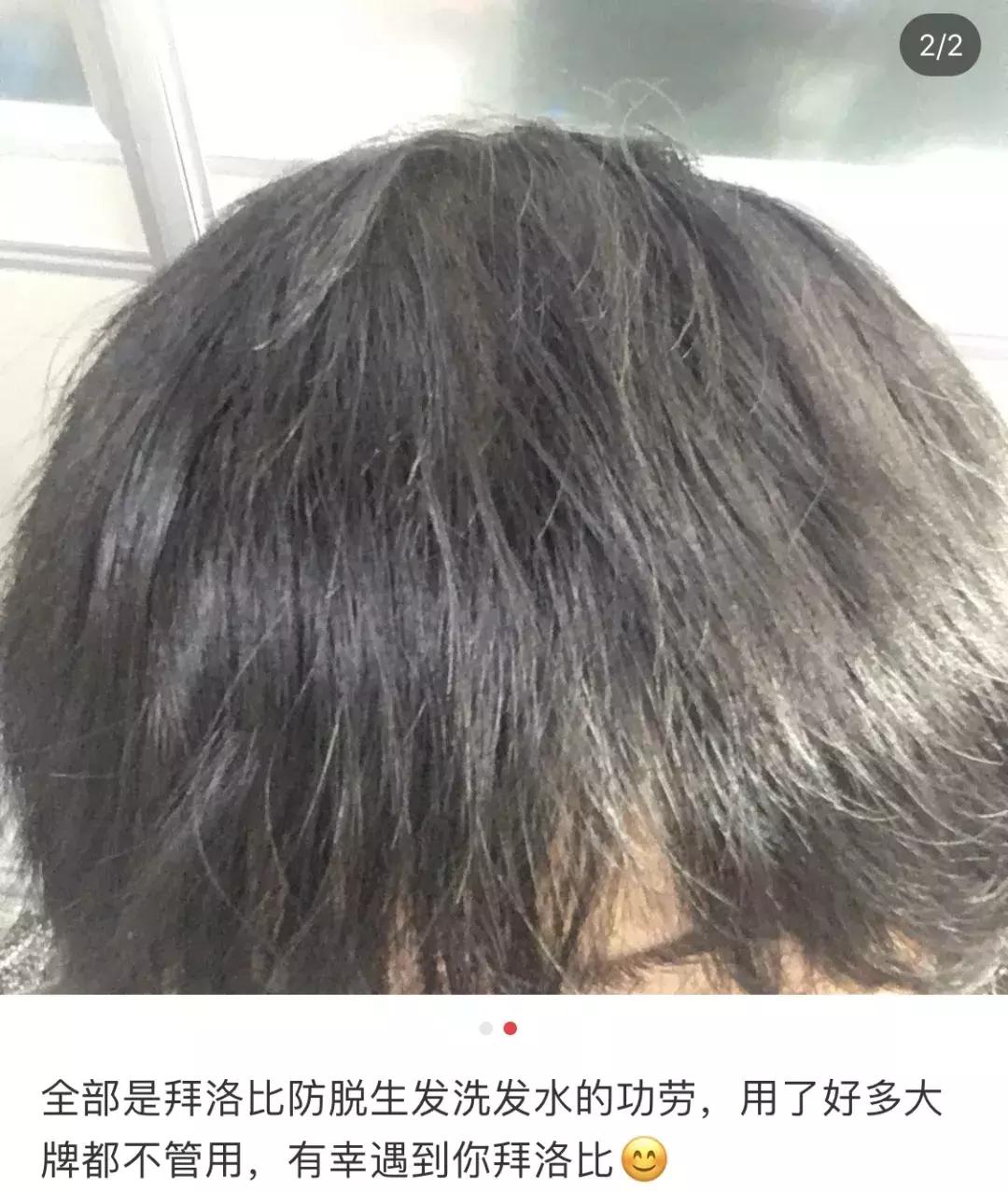 头发毛躁并且脱发推荐洗发水,用什么洗发水改善头皮脱发