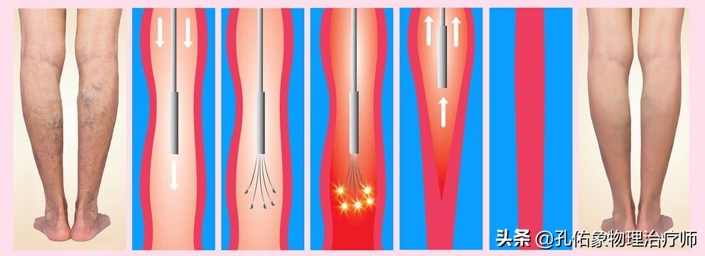 腿上细血管像蜘蛛样怎么回事,小腿上的血管像小蚯蚓一样
