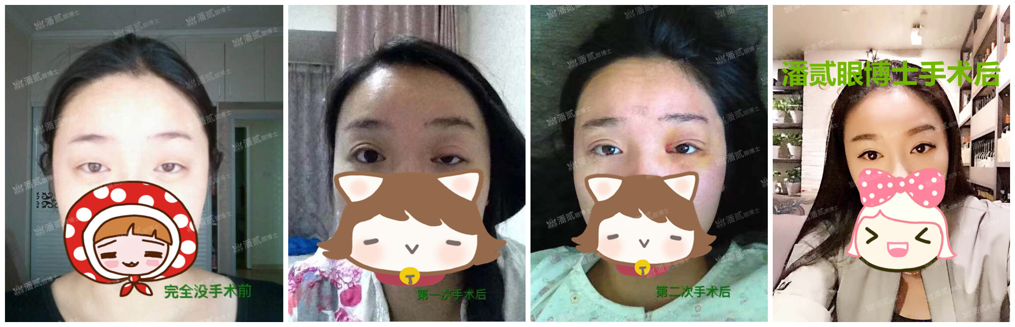 提肌矫正失败的表现眼皮睁不开,做完提肌眼睛前半段下垂