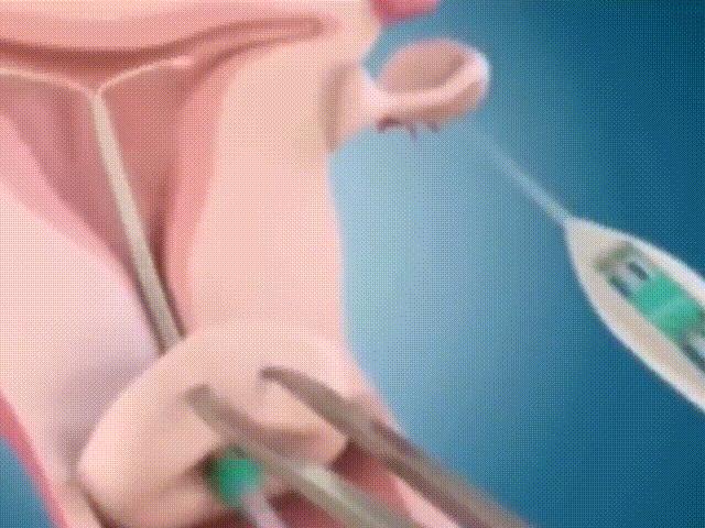 被妈妈遗忘的节育环,被人遗忘的节育环