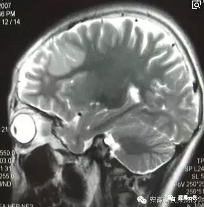 脑部脓肿怎么治疗,多发性脑脓肿能自愈吗
