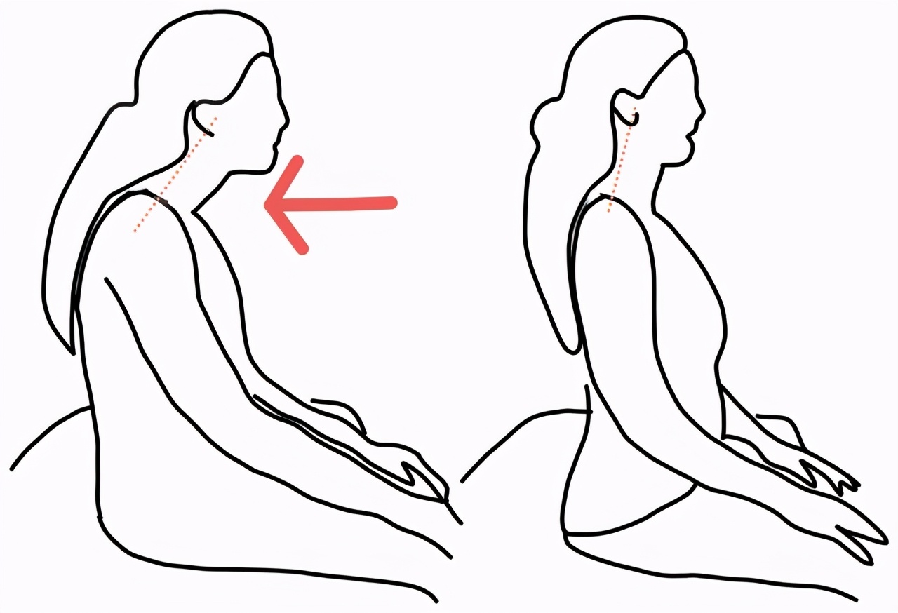 如何改变驼背和头前伸,如何改变坐姿驼背