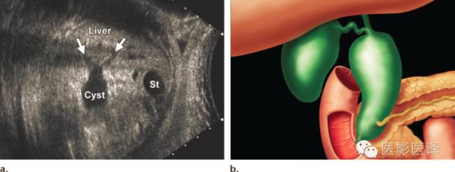 孕期发现卵巢囊肿有8cm左右,孕19周查出胎儿卵巢囊肿
