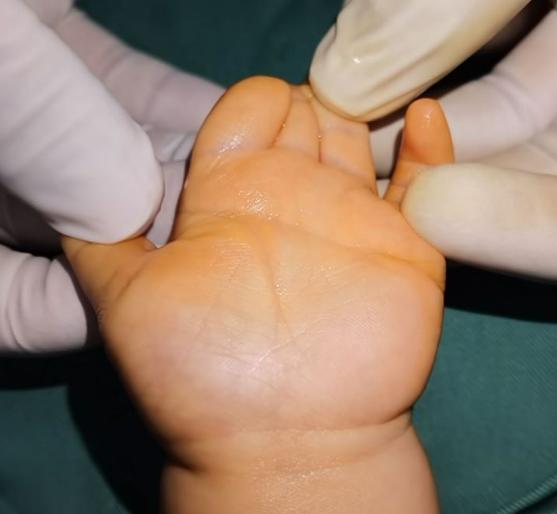 并指畸形免植皮案例,并指畸形