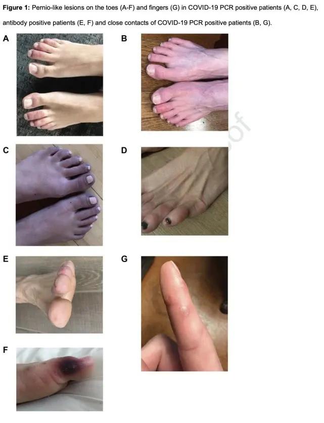 皮肤接触会感染新冠吗,警惕身体出现的现象