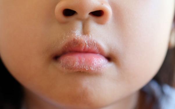 秋天嘴巴干裂起皮最快的解决方法,一到秋天嘴唇就干燥脱皮中医