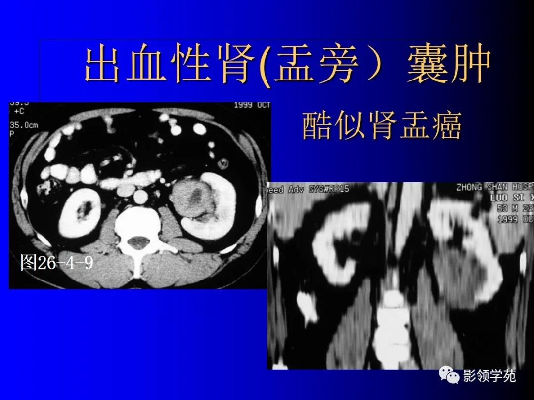 肾脏囊性肿块的影像学特点,肾脏典型病理图片及解析
