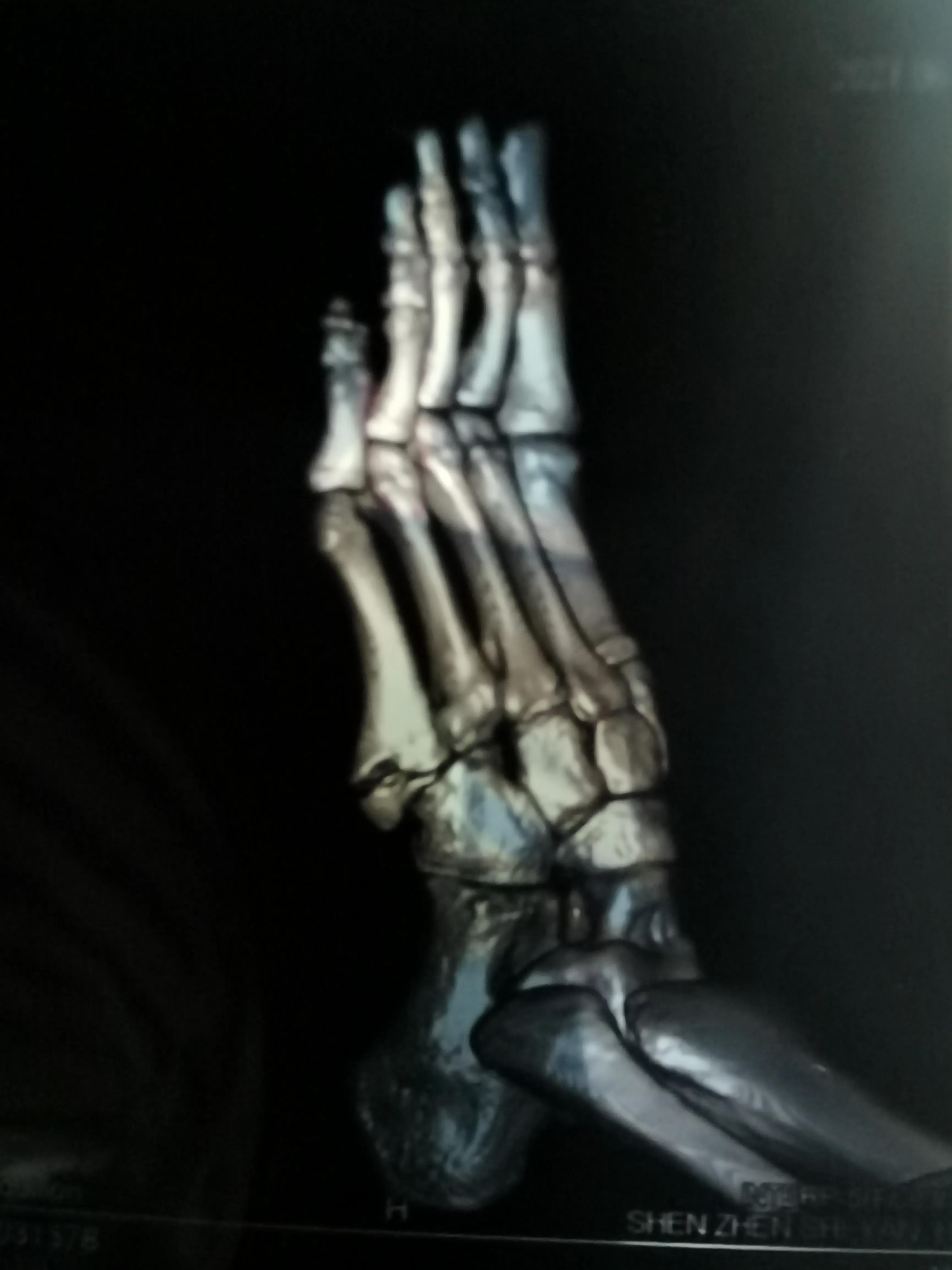 第五跖骨粉碎性骨折多久后能走路,第五跖骨基底骨折100天了走路肿