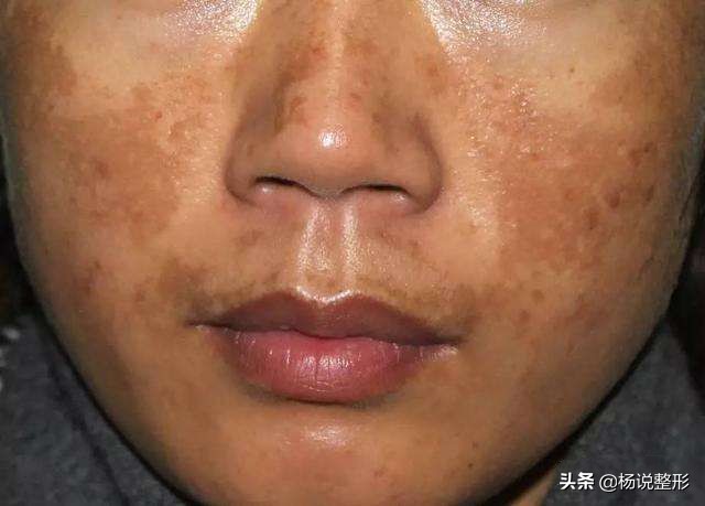 祛斑干货！内服、外调*管双**齐下，具体怎么做？