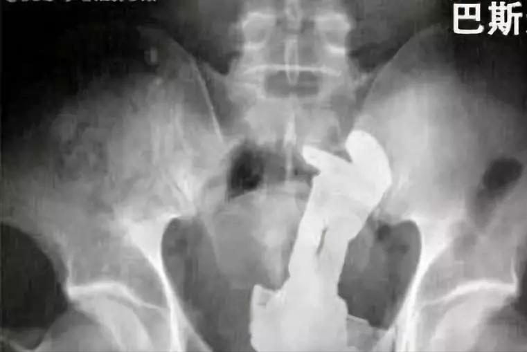 50cm“仙女管”插入少女胃里,这种自虐工具竟在淘宝卖疯了