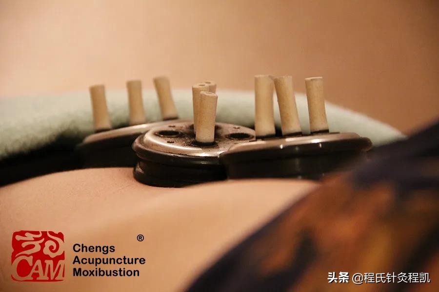 程凯养生说荨麻疹与湿疹的区别,程凯针灸调理荨麻疹