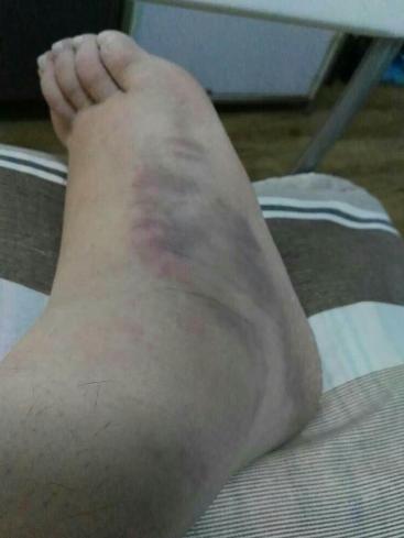 医生讲解脚扭伤问题,急性脚扭伤正确的处理方法