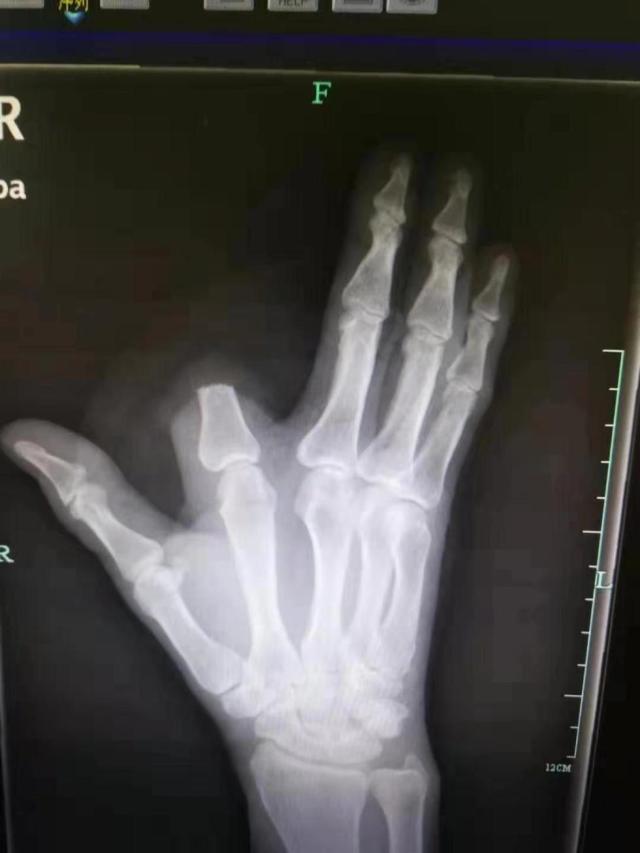 男子被五步蛇咬伤一刀斩断手指,男子被五步蛇咬后七孔流血