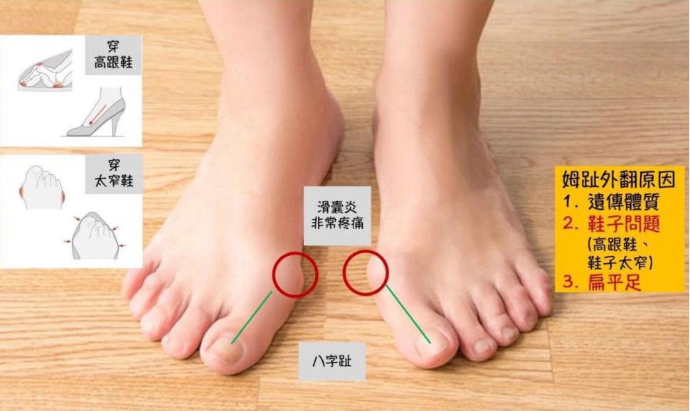 什么是拇趾外翻,拇趾外翻最好的锻炼方法