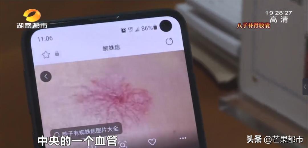 身上长这3种痣要警惕,身体上有这种痣要当心