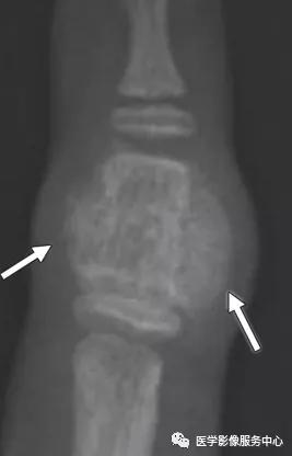 手腕撕脱性骨折一年了还隐隐作痛,手腕三角骨撕脱骨折症状有哪些