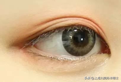 修复双眼皮眼角有分叉怎么办,双眼皮修复折痕分叉