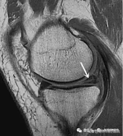 内侧半月板后角损伤怎么治疗,prp治疗半月板损伤有用吗