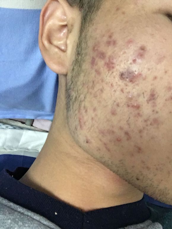 22岁男生脸上的痘痘怎样去除,脸上长痘痘如何快速消痘不留痘印