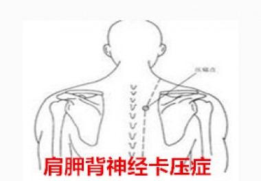肩胛背神经卡压的病因,肩胛背神经卡压来自哪里