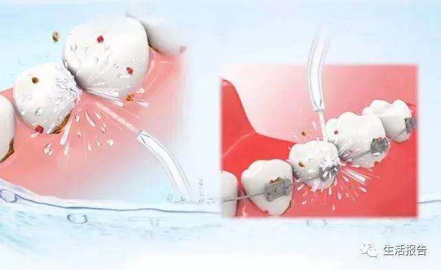 冲牙器水牙线实测,水牙线冲牙器品牌哪个好用