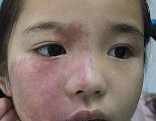 婴儿有胎记如何确认是红瘤,宝宝生下来的胎记