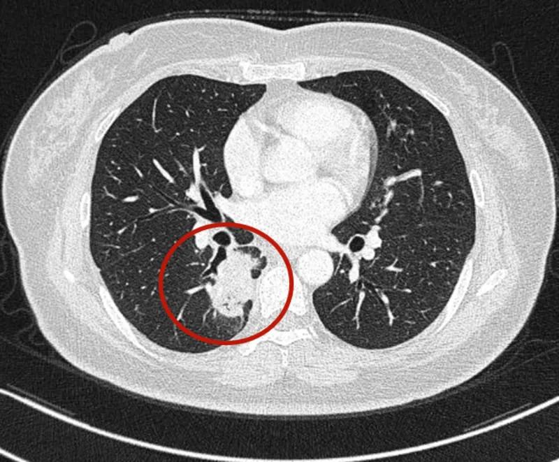右肺下叶微小结节是什么意思,诊断报告左肺下微小结节没写大小