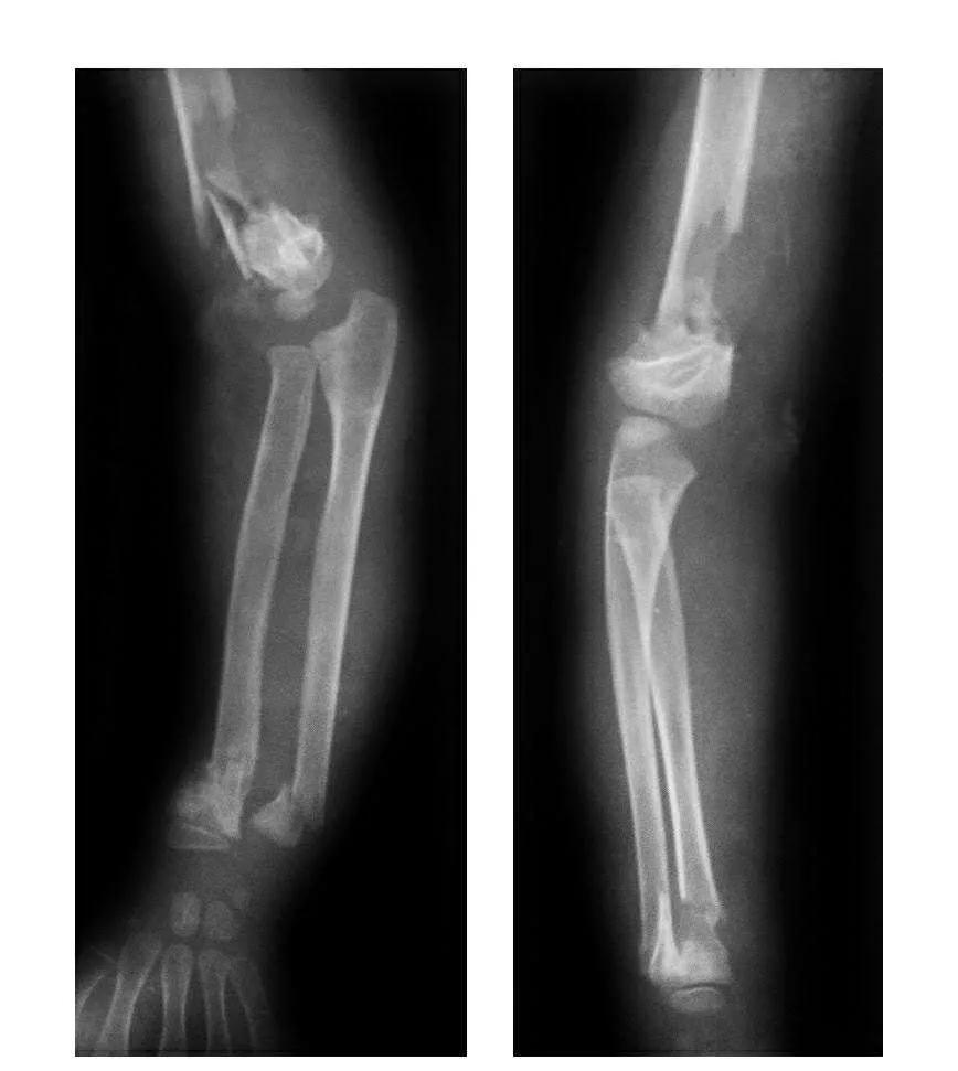 青少年肘部损伤最常见的是,肘部桡神经损伤的临床表现