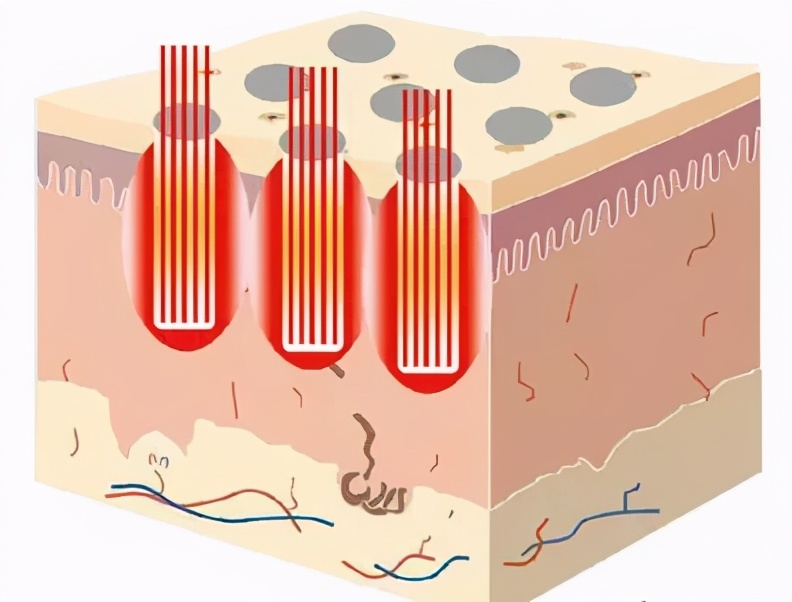 老化毛孔粗大能收缩回去吗,挤完黑头毛孔粗大能缩回去吗