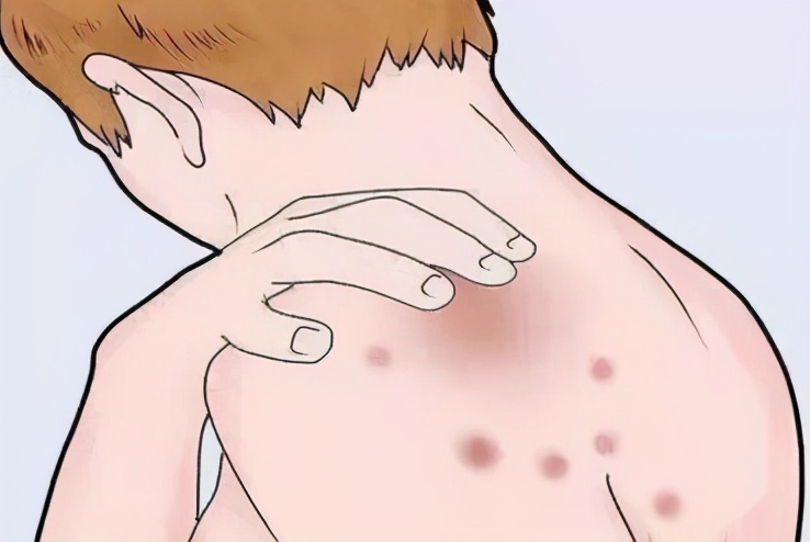 中医教你一招解决玫瑰糠疹,中医专家说健康