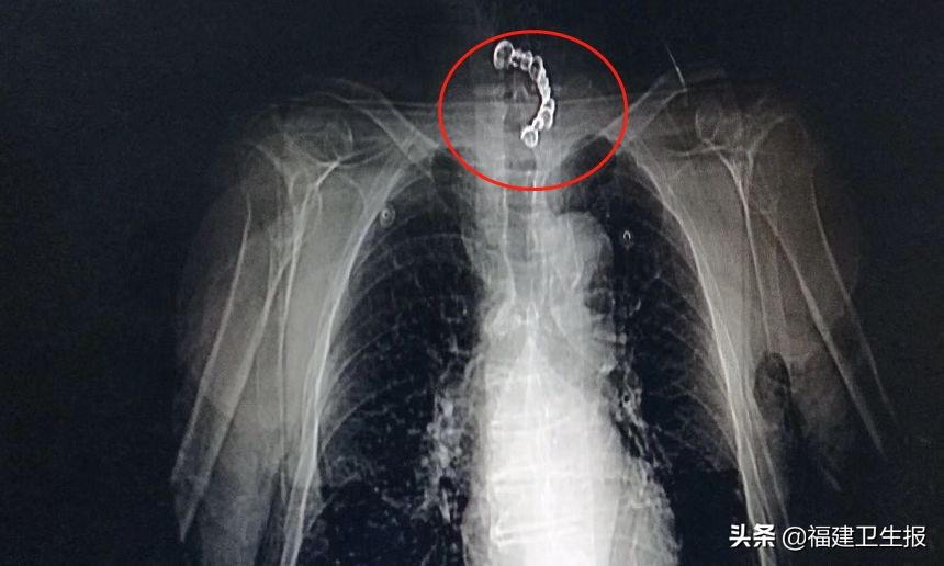 老人误吞假牙,大爷误吞两颗假牙