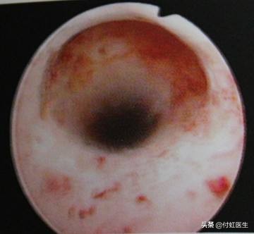 剖宫产后2年B超发现子宫里面出了“套间”，影响我要二宝吗？