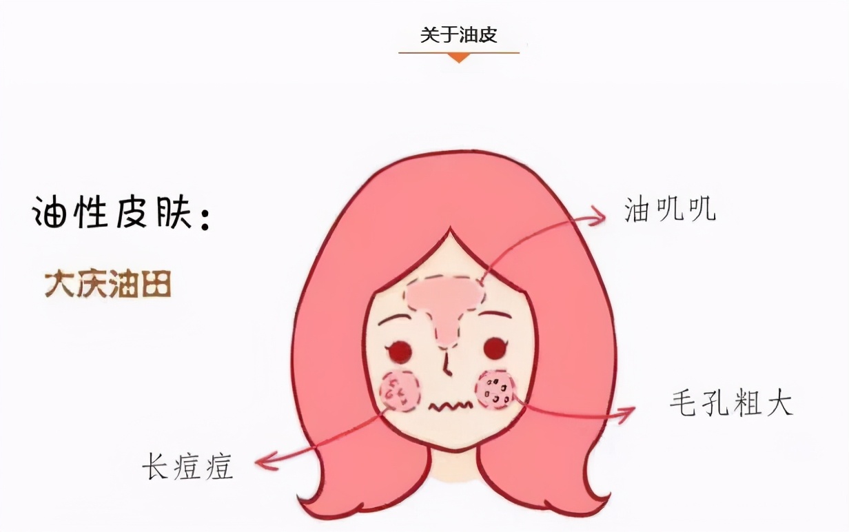 皮肤粗糙毛孔粗大出油改善方法,皮肤出油毛孔粗大吃什么药改善