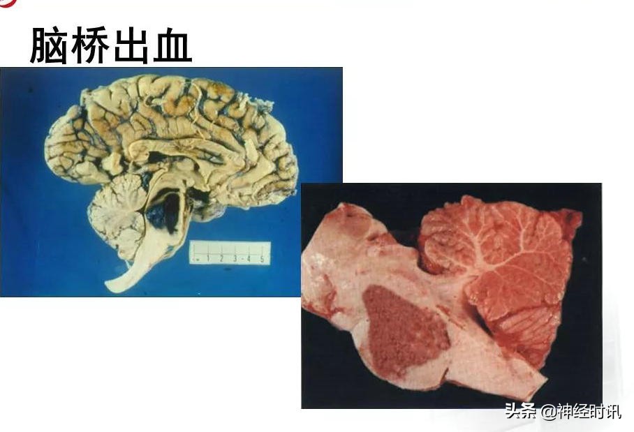 脑动脉解剖学讲解,基底节区脑血管解剖