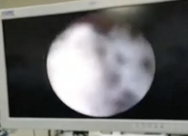 两岁女宝宝小便里面出血,儿童自发性出血