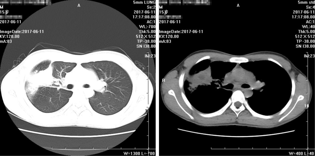 如何在CAP初始治疗后72h内进行病情评价？其成功关键有哪些？