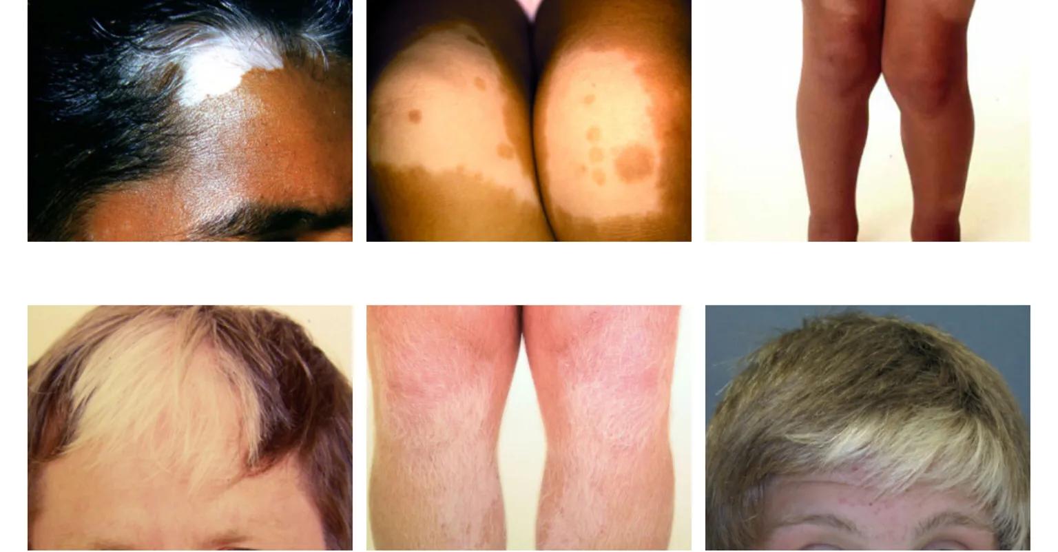 咨询故事：这个孩子额头的白斑是什么病？