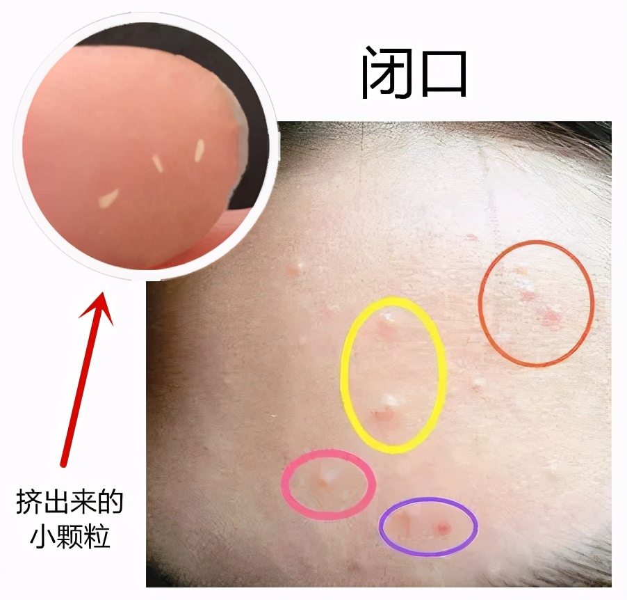 被挤发炎的闭口怎么处理,被挤了的闭口粉刺如何快速好