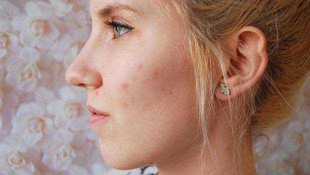 祛痘印用什么精油比较好,祛痘印精油在什么步骤用