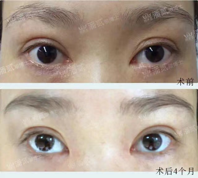 开内眼角会留疤的照片,开内眼角的疤痕变白色了怎么办