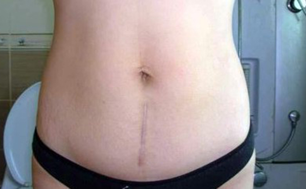 剖腹产的疤痕跟什么疤痕像,女人剖腹产疤痕十年后还有疤痕吗