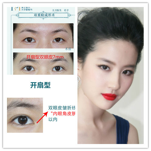 为什么有人割了双眼皮反而不好看,为啥有些人割了双眼皮变化巨大